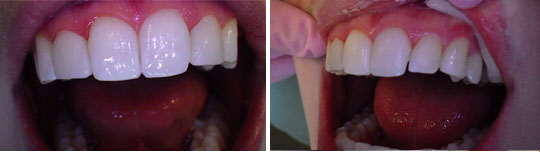 Patient 1, composite veneers photo 1