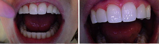 Patient 1, composite veneers photo 3