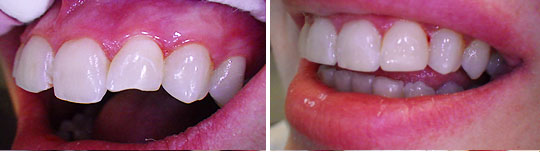 Patient 2, composite veneers photo 1