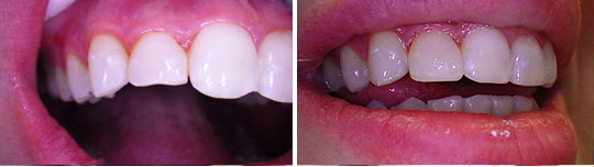 Patient 2, composite veneers photo 2