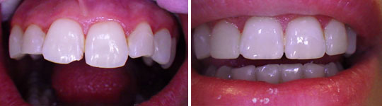 Patient 2, composite veneers photo 3